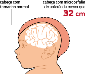 microcefalia-cabeca