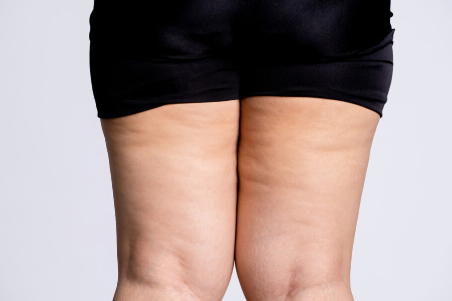 lipedema 910x607 1 - Lipedema: entenda os sintomas e a importância do diagnóstico precoce