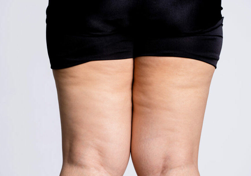 lipedema-910x607-1